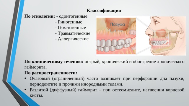 Классификация По этиологии: - одонтогенные  - Риногенные  - Гематогенные  - Травматические  - Аллергические По клиническому течению: острый, хронический и обострение хронического гайморита. По распространенности: Очаговый (ограниченный) часто возникает при перфорации дна пазухи, периодонтите и прочими инородными телами. Разлитой (диффузный) гайморит – при остеомиелите, нагноении корневой кисты. 