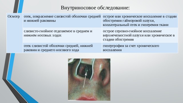 Внутриносовое обследование: Осмотр   отек, покраснение слизистой оболочки средней и нижней раковины   острое или хроническое воспаление в стадии обострения гайморовой пазухи, коллатеральный отек и гиперемия ткани слизисто-гнойное отделяемое в среднем и нижнем носовых ходах   острое серозно-гнойное воспаление верхнечелюстной пазухи или хроническое в стадии обострения отек слизистой оболочки средней, нижней раковин и среднего носового хода гипертрофия за счет хронического воспаления 