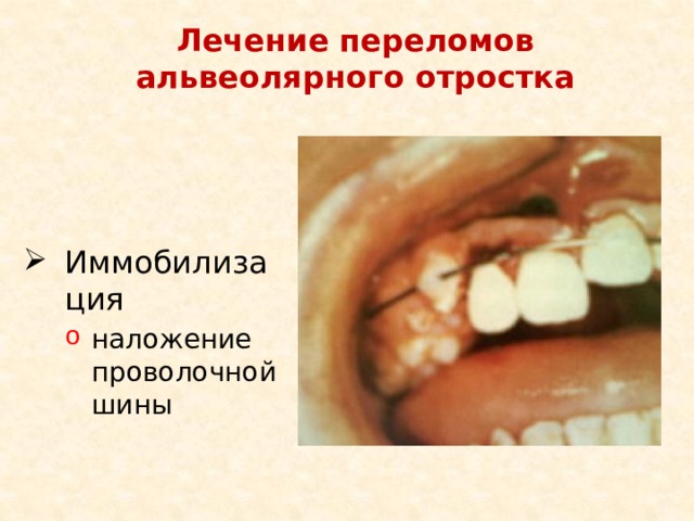 Лечение переломов альвеолярного отростка Иммобилизация наложение проволочной шины 