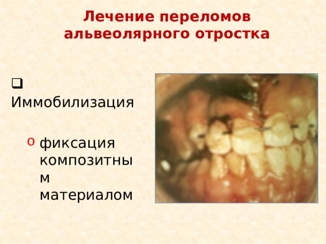 Лечение переломов альвеолярного отростка  Иммобилизация фиксация композитным материалом 