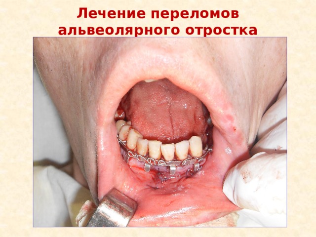 Лечение переломов альвеолярного отростка 