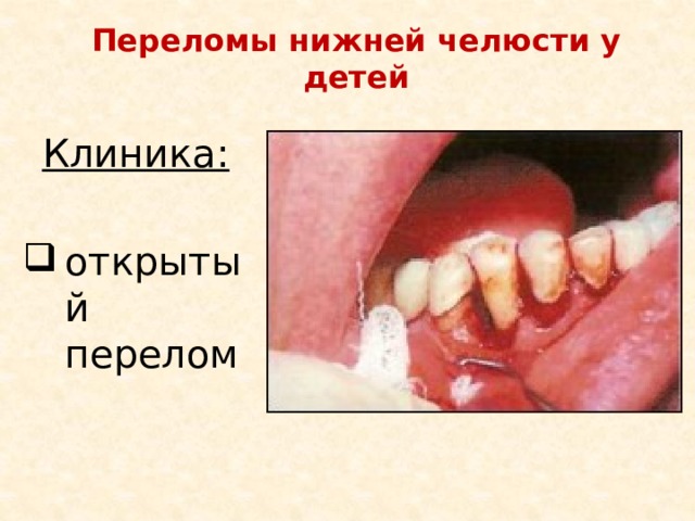 Переломы нижней челюсти у детей Клиника:  открытый перелом 