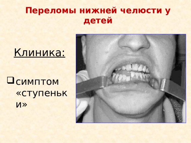 Переломы нижней челюсти у детей Клиника:  симптом «ступеньки» 