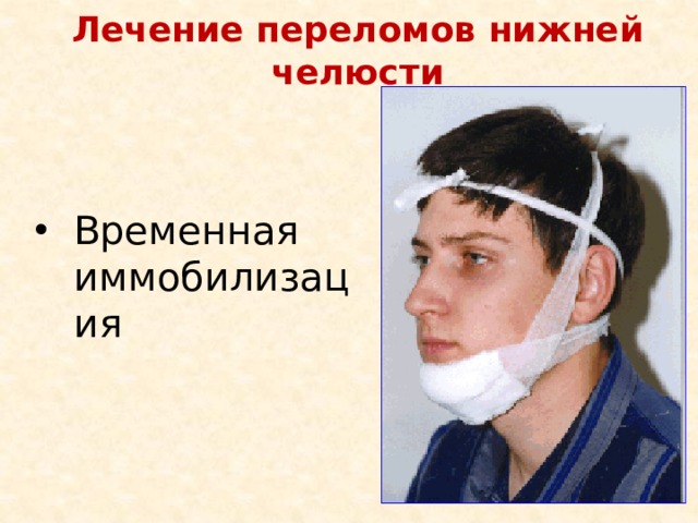 Лечение переломов нижней челюсти Временная иммобилизация 