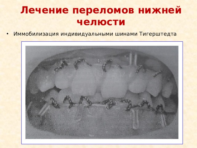 Лечение переломов нижней челюсти Иммобилизация индивидуальными шинами Тигерштедта 