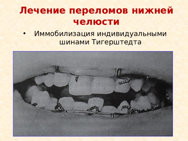 Лечение переломов нижней челюсти Иммобилизация индивидуальными шинами Тигерштедта 