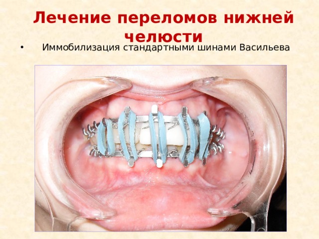 Лечение переломов нижней челюсти Иммобилизация стандартными шинами Васильева 