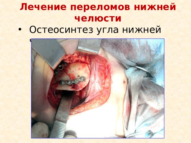 Лечение переломов нижней челюсти Остеосинтез угла нижней челюсти 