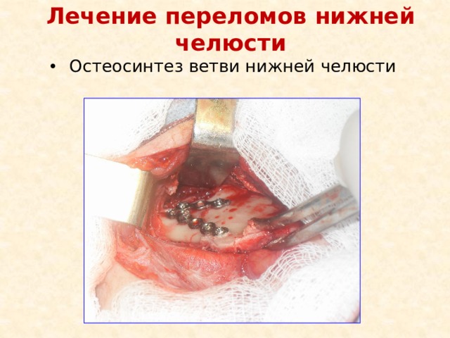 Лечение переломов нижней челюсти Остеосинтез ветви нижней челюсти 
