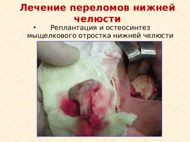 Лечение переломов нижней челюсти Реплантация и остеосинтез мыщелкового отростка нижней челюсти 