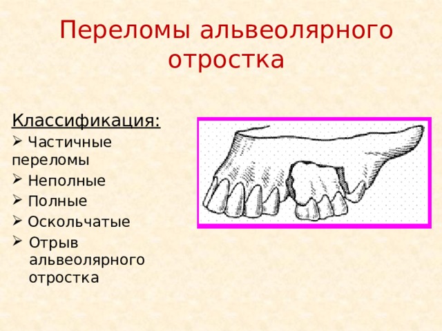 Переломы альвеолярного отростка Классификация:  Частичные переломы  Неполные  Полные  Оскольчатые Отрыв альвеолярного отростка 