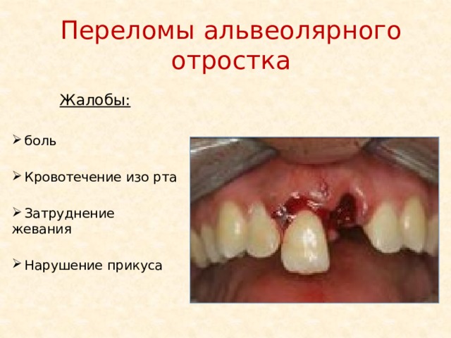 Переломы альвеолярного отростка Жалобы:   боль  Кровотечение изо рта  Затруднение жевания  Нарушение прикуса 
