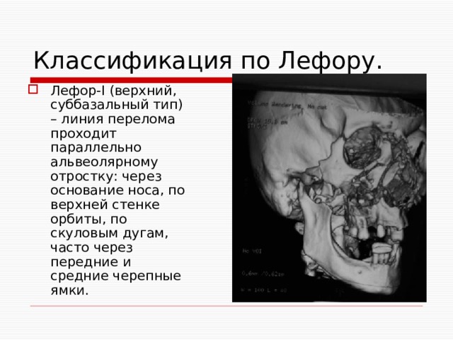 Классификация по Лефору. Лефор-I (верхний, суббазальный тип) – линия перелома проходит параллельно альвеолярному отростку: через основание носа, по верхней стенке орбиты, по скуловым дугам, часто через передние и средние черепные ямки. 
