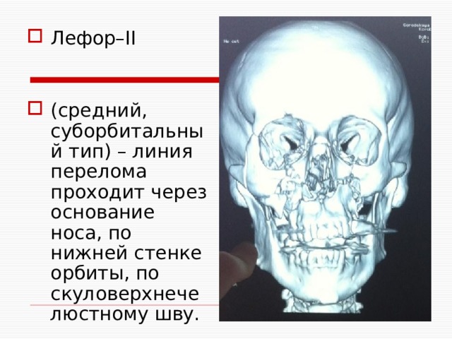 Лефор–II (средний, суборбитальный тип) – линия перелома проходит через основание носа, по нижней стенке орбиты, по скуловерхнечелюстному шву. 