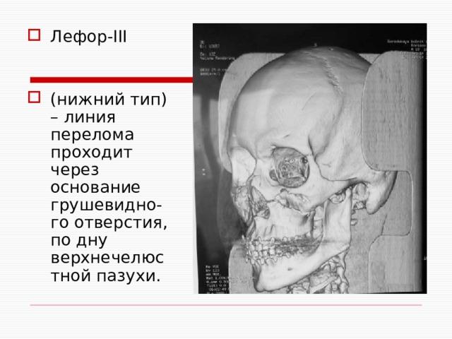 Лефор-III (нижний тип) – линия перелома проходит через основание грушевидно-го отверстия, по дну верхнечелюстной пазухи. 