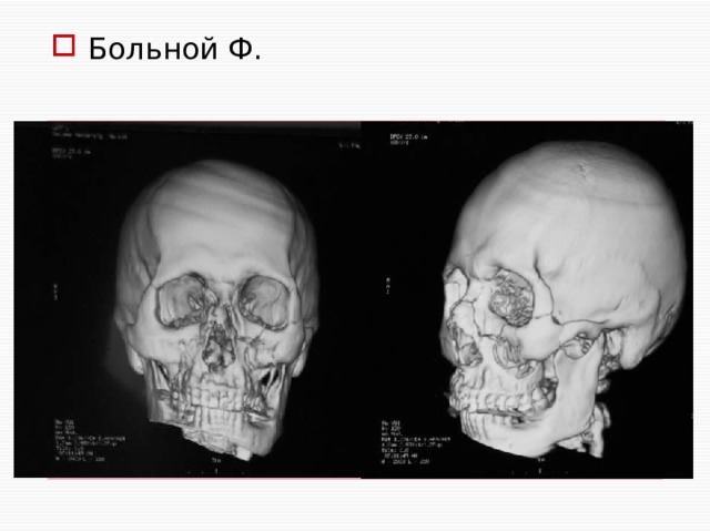 Больной Ф. 