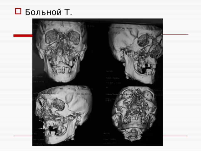 Больной Т. 