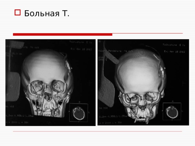 Больная Т. 