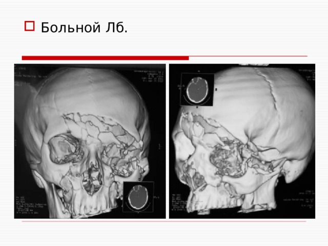Больной Лб. 