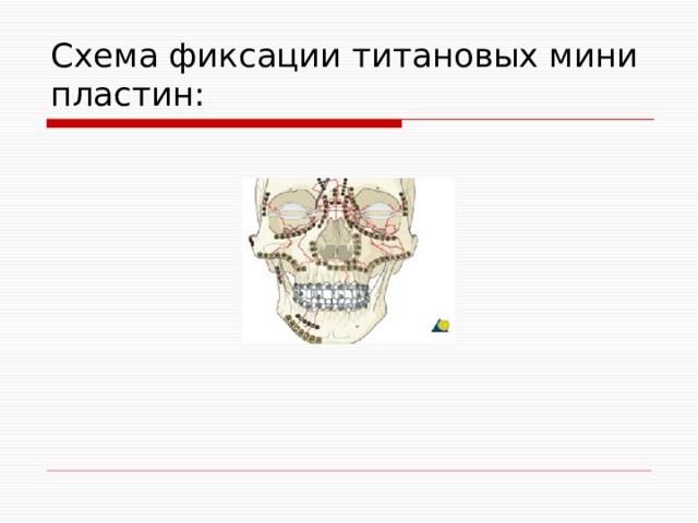 Схема фиксации титановых мини пластин: 