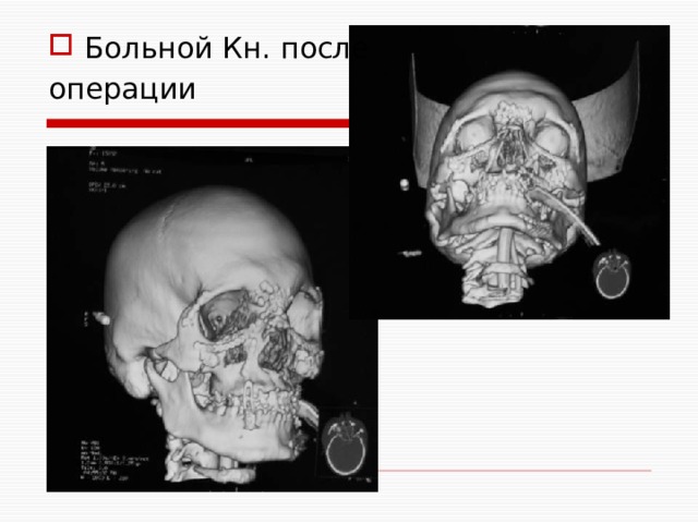 Больной Кн. после операции 