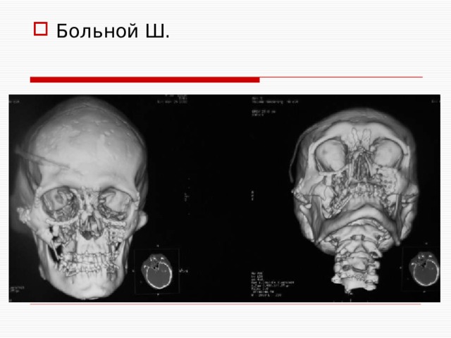Больной Ш. 