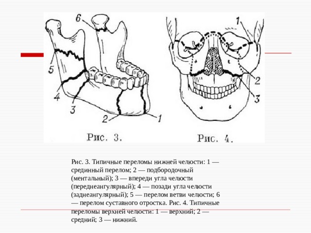 Рис. 3. Типичные переломы нижней челюсти: 1 — срединный перелом; 2 — подбородочный (ментальный); 3 — впереди угла челюсти (переднеангулярный); 4 — позади угла челюсти (заднеангулярный); 5 — перелом ветви челюсти; 6 — перелом суставного отростка. Рис. 4. Типичные переломы верхней челюсти: 1 — верхний; 2 — средний; 3 — нижний. 