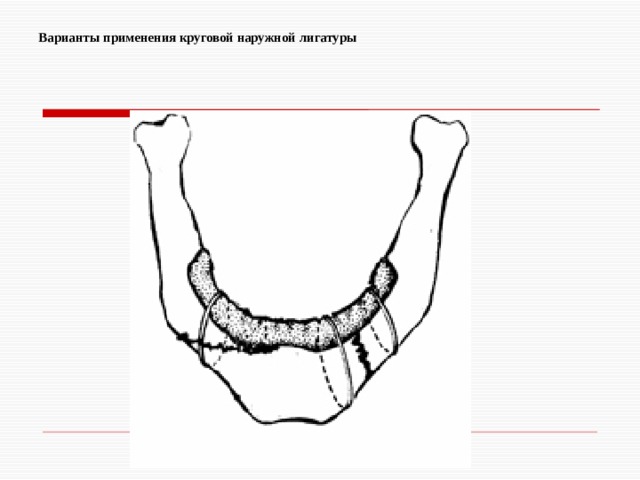 Варианты применения круговой наружной лигатуры   