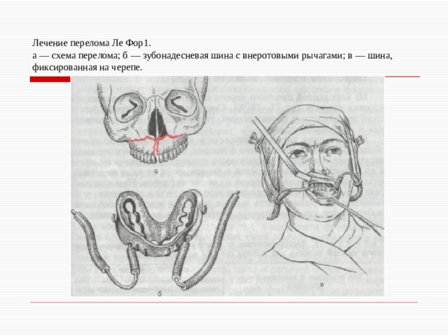 Лечение перелома Ле Фор1.  а — схема перелома; б — зубонадесневая шина с внеротовыми рычагами; в — шина, фиксированная на черепе. 