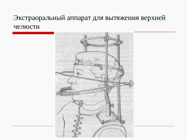 Экстраоральный аппарат для вытяжения верхней челюсти 
