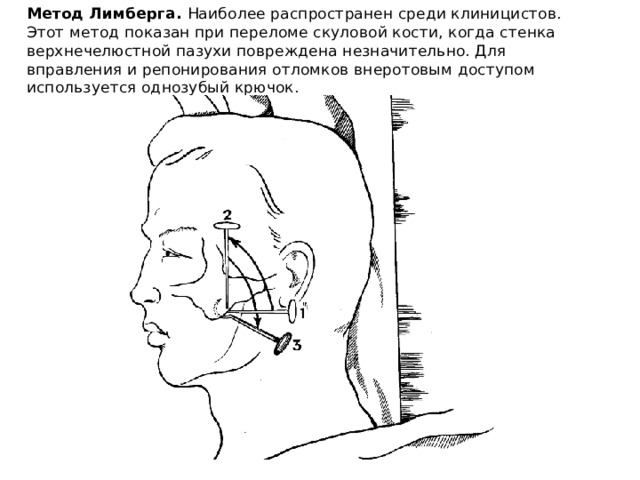 Перелом верхней стенки верхнечелюстной пазухи