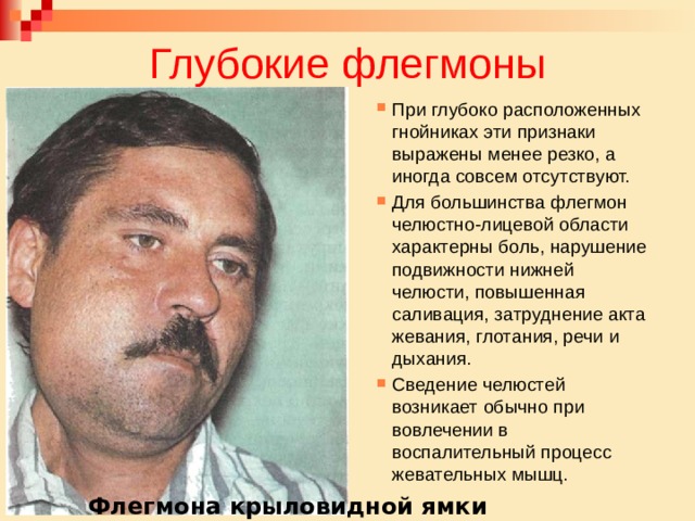 Глубокие флегмоны При глубоко расположенных гнойниках эти признаки выражены менее резко, а иногда совсем отсутствуют. Для большинства флегмон челюстно-лицевой области характерны боль, нарушение подвижности нижней челюсти, повышенная саливация, затруднение акта жевания, глотания, речи и дыхания. Сведение челюстей возникает обычно при вовлечении в воспалительный процесс жевательных мышц. Флегмона крыловидной ямки 