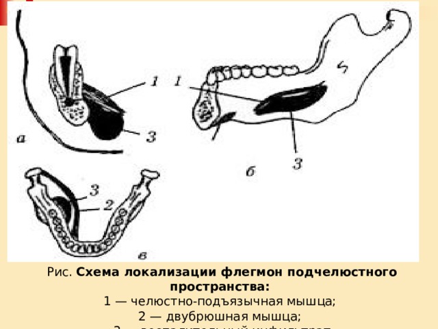 Рис. Схема локализации флегмон подчелюстного пространства:   1 — челюстно-подъязычная мышца;  2 — двубрюшная мышца; 3 — воспалительный инфильтрат 