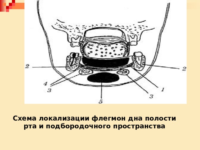 Схема локализации флегмон дна полости рта и подбородочного пространства 