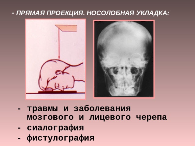 При укладке черепа в прямой проекции центральный луч направлен к деке стола