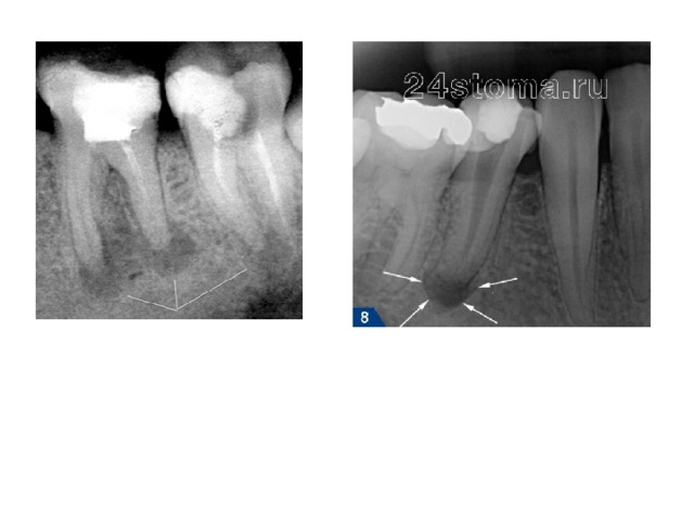 Рентгенологическая картина периодонтита