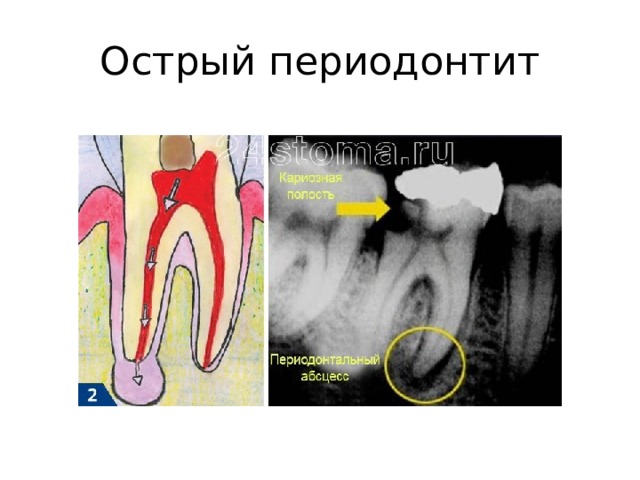 Периодонтите зуба острый лечение. Апикальный периодонтит рентген.