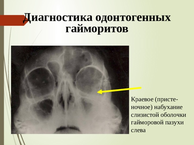 Перелом верхней стенки верхнечелюстной пазухи