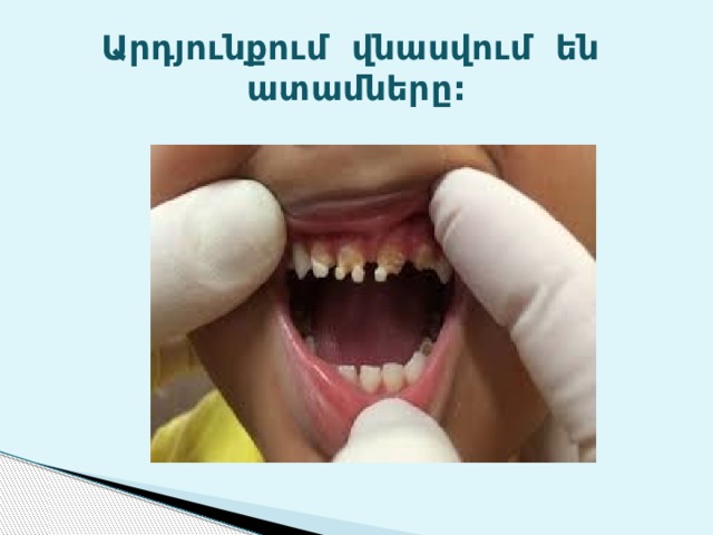 Արդյունքում վնասվում են ատամները: 