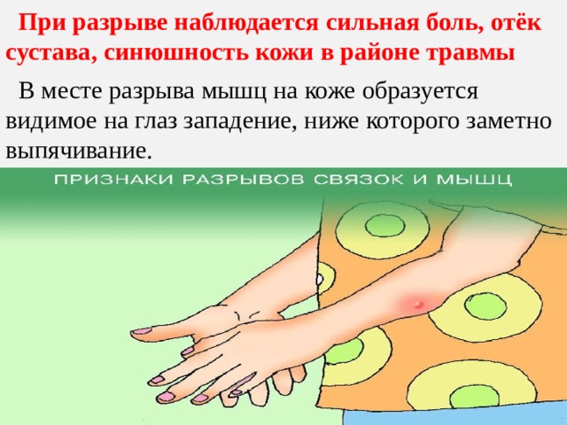  При разрыве наблюдается сильная боль, отёк сустава, синюшность кожи в районе травмы  В месте разрыва мышц на коже образуется видимое на глаз западение, ниже которого заметно выпячивание. 