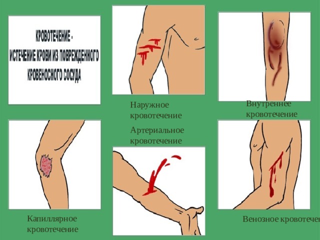 Внутреннее кровотечение Наружное кровотечение Артериальное кровотечение Капиллярное кровотечение Венозное кровотечение 