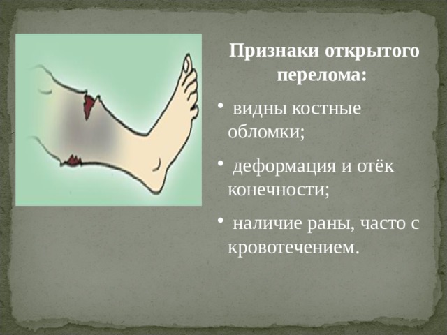 Признаки открытого перелома конечностей. Признаки открытого перелома. Назовите признаки открытого перелома. Открытый перелом признаки. Характерный симптом открытого перелома:.