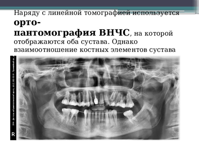 Тест рентгенологическая картина при артрозах внчс