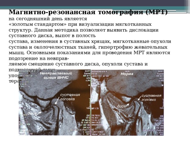 Для диагностики смещения суставного диска височно нижнечелюстного сустава внчс применяют метод