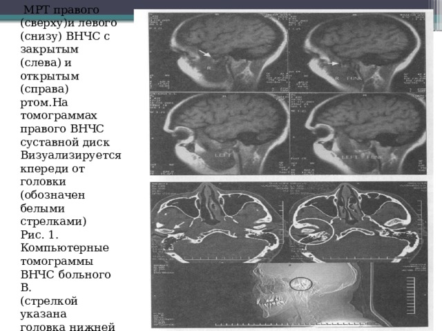 Презентация мрт внчс