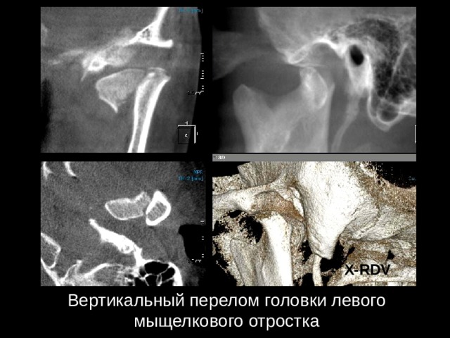 Лучевая диагностика внчс презентация