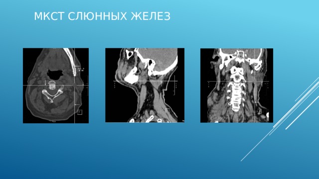 МКСТ слюнных желез Норма Аксиальный срез Сагиттальный Фронтальный  