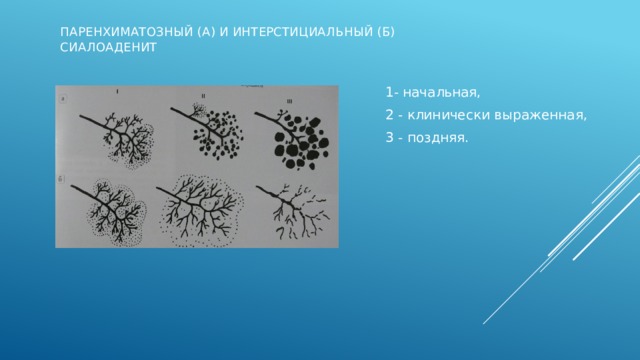 Паренхиматозный (а) и интерстициальный (б) сиалоаденит 1- начальная, 2 - клинически выраженная, 3 - поздняя. Острое воспаление слюнных желез – сиалоаденит. Паренхимат. (паротит)Сиалоаденит 1 - паренхима железы видна нечетко, визуализируются единичные округлые скопления контрастного препарата диаметром 1-2 мм. Иногда вовлечена симметричная железа. П.с.2- множество полостей диаметром 2-3 мм, протоки порядков не определяются или прерывисты. П.с.3- образование абсцессов и рубцевание. Множественные разнокалиберные скопления контраста – полости абсцессов, протоки IV, V порядков сужены, или отсутствуют. Интерстиц. с (паренхима – диффузное скопление лимфоидных элементов).1- неравномреность изображения паренхимы и сужение протоков III, IV, V порядков. И.с.2 – железа увеличена, резко сужены протоки II-IV порядков, контуры протоков ровные и четкие. И.С.3 –паренхима не поределяется , все протоки сужены, контуры их неровные. И.с.2 -  