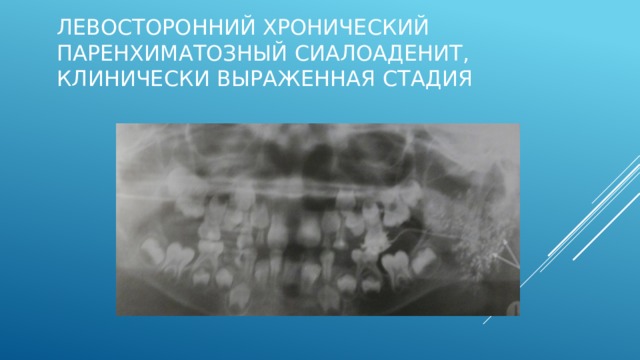 Левосторонний хронический паренхиматозный сиалоаденит, клинически выраженная стадия Ортопантомосиалограмма ребенка 5,5 лет. Протоки 1, 2 и 3 порядков не определяются, множество полостей диаметром 2-3 мм, заполненных контрастом.  