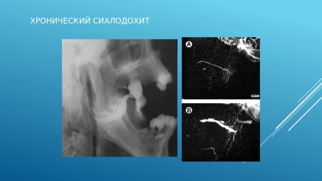 Схематическое изиображение сиалограмм при хроническом сиалодохите на разных стадиях:   1- начальная, 2 - клинически выраженная, 3 - поздняя. Начальная- главный выводной проток неравномерно расширен или не изменен, расширены протоки I,II, иногда 2-IV порядков. Вид четок- расширенные участки чередуются с неизмененными. 2- просвет протоков значительно расширен, контуры неровные четкие, чередовние расширений с сужениями. 3- участки расширения и сужения протоков чередуются , иногда ход протоков прерывается.  